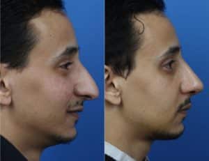 Washington DC Facelift Surgery Helps Define Facial Contours